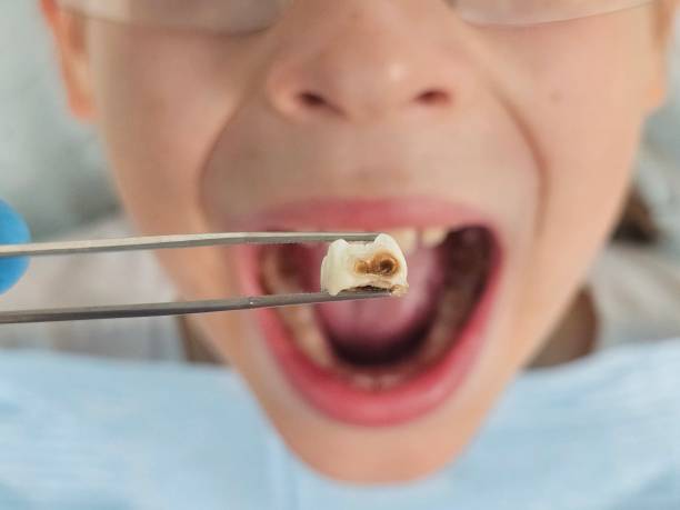 Best Emergency Dentist for Lost Fillings or Crowns in Sisco Heights, WA